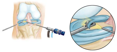 Advanced Arthroscopic Treatment in Mumbai