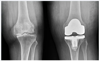 Total knee replacement surgeon in Mumbai